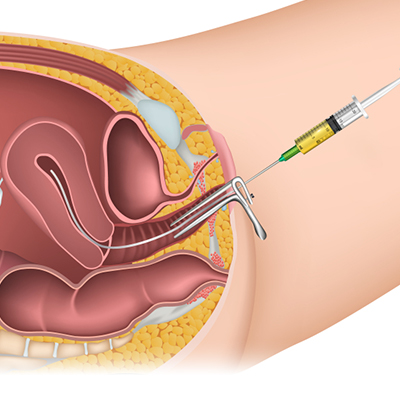 IUI Treatment in Karimnagar